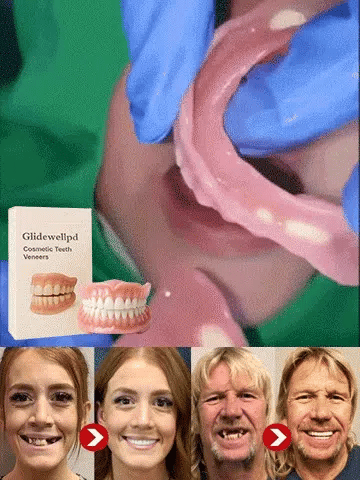🦷[Epic Upgrade] Premium Full Cover Dentures🦷