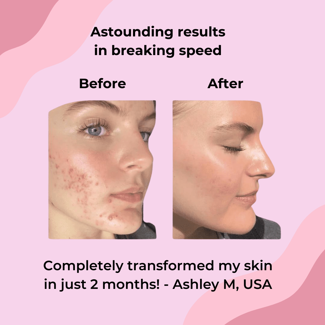 🍋	 Last Day Buy 1 Get 1 Free🔥Turmeric Kojic Acid Cleansing Pads🍋